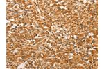 The image on the left is immunohistochemistry of paraffin-embedded Human thyroid cancer tissue using CSB-PA788468(BCL2L14 Antibody) at dilution 1/40, on the right is treated with fusion protein. (Original magnification: 
