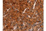 The image on the left is immunohistochemistry of paraffin-embedded Human liver cancer tissue using CSB-PA789110(ARRB1 Antibody) at dilution 1/15, on the right is treated with synthetic peptide. (Original magnification: 