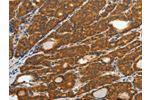 The image on the left is immunohistochemistry of paraffin-embedded Human thyroid cancer tissue using CSB-PA790121(CRP Antibody) at dilution 1/40, on the right is treated with fusion protein. (Original magnification: 