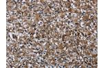 The image on the left is immunohistochemistry of paraffin-embedded Human prostate cancer tissue using CSB-PA790157(FAM89B Antibody) at dilution 1/20, on the right is treated with fusion protein. (Original magnification: 