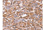 The image on the left is immunohistochemistry of paraffin-embedded Human thyroid cancer tissue using CSB-PA790504(FAM13B Antibody) at dilution 1/30, on the right is treated with synthetic peptide. (Original magnification: 