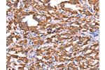 The image on the left is immunohistochemistry of paraffin-embedded Human thyroid cancer tissue using CSB-PA790564(FXR1 Antibody) at dilution 1/20, on the right is treated with synthetic peptide. (Original magnification: 