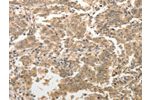 The image on the left is immunohistochemistry of paraffin-embedded Human gastic cancer tissue using CSB-PA790607(ADAR Antibody) at dilution 1/40, on the right is treated with synthetic peptide. (Original magnification: 