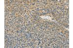 The image on the left is immunohistochemistry of paraffin-embedded Human liver cancer tissue using CSB-PA790667(ASPA Antibody) at dilution 1/80, on the right is treated with fusion protein. (Original magnification: 