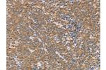 The image on the left is immunohistochemistry of paraffin-embedded Human Lymphoma tissue using CSB-PA790945(CD2AP Antibody) at dilution 1/70, on the right is treated with synthetic peptide. (Original magnification: 