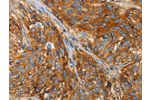 The image on the left is immunohistochemistry of paraffin-embedded Human esophagus cancer tissue using CSB-PA791042(B2M Antibody) at dilution 1/25, on the right is treated with fusion protein. (Original magnification: 
