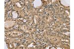 The image on the left is immunohistochemistry of paraffin-embedded Human thyroid cancer tissue using CSB-PA791503(CENPV Antibody) at dilution 1/40, on the right is treated with synthetic peptide. (Original magnification: 