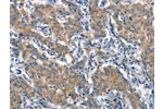 The image on the left is immunohistochemistry of paraffin-embedded Human gastic cancer tissue using CSB-PA791537(CRIM1 Antibody) at dilution 1/25, on the right is treated with synthetic peptide. (Original magnification: 