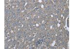 The image on the left is immunohistochemistry of paraffin-embedded Human ovarian cancer tissue using CSB-PA793275(EZR Antibody) at dilution 1/20, on the right is treated with fusion protein. (Original magnification: 