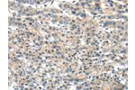 The image on the left is immunohistochemistry of paraffin-embedded Human liver cancer tissue using CSB-PA793564(DNAJA3 Antibody) at dilution 1/30, on the right is treated with fusion protein. (Original magnification: 