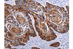 The image on the left is immunohistochemistry of paraffin-embedded Human esophagus cancer tissue using CSB-PA793636(DEFA1 Antibody) at dilution 1/15, on the right is treated with synthetic peptide. (Original magnification: 