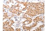 The image on the left is immunohistochemistry of paraffin-embedded Human lung cancer tissue using CSB-PA793937(CCR3 Antibody) at dilution 1/40, on the right is treated with synthetic peptide. (Original magnification: 