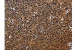 The image on the left is immunohistochemistry of paraffin-embedded Human cervical cancer tissue using CSB-PA794242(EXTL3 Antibody) at dilution 1/50, on the right is treated with fusion protein. (Original magnification: 