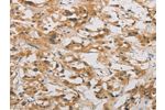 The image on the left is immunohistochemistry of paraffin-embedded Human thyroid cancer tissue using CSB-PA794556(DDIT4 Antibody) at dilution 1/20, on the right is treated with fusion protein. (Original magnification: 