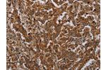 The image on the left is immunohistochemistry of paraffin-embedded Human liver cancer tissue using CSB-PA794578(ATP2A1 Antibody) at dilution 1/30, on the right is treated with synthetic peptide. (Original magnification: 