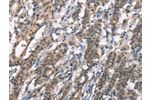 The image on the left is immunohistochemistry of paraffin-embedded Human gastic cancer tissue using CSB-PA794725(DGAT1 Antibody) at dilution 1/40, on the right is treated with synthetic peptide. (Original magnification: 