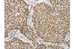 The image on the left is immunohistochemistry of paraffin-embedded Human lung cancer tissue using CSB-PA795084(DNAJB1 Antibody) at dilution 1/20, on the right is treated with fusion protein. (Original magnification: 