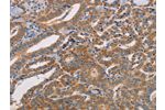 The image on the left is immunohistochemistry of paraffin-embedded Human thyroid cancer tissue using CSB-PA795237(CDK11A/CDK11B Antibody) at dilution 1/50, on the right is treated with synthetic peptide. (Original magnification: 