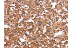 The image on the left is immunohistochemistry of paraffin-embedded Human thyroid cancer tissue using CSB-PA795553(CRISP3 Antibody) at dilution 1/50, on the right is treated with fusion protein. (Original magnification: 