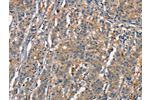 The image on the left is immunohistochemistry of paraffin-embedded Human gastic cancer tissue using CSB-PA795702(CEACAM3 Antibody) at dilution 1/30, on the right is treated with synthetic peptide. (Original magnification: 