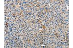 The image on the left is immunohistochemistry of paraffin-embedded Human liver cancer tissue using CSB-PA795997(APOH Antibody) at dilution 1/15, on the right is treated with fusion protein. (Original magnification: 