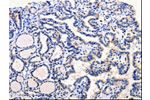 The image on the left is immunohistochemistry of paraffin-embedded Human thyroid cancer tissue using CSB-PA796026(ARL6 Antibody) at dilution 1/25, on the right is treated with fusion protein. (Original magnification: 