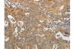 The image on the left is immunohistochemistry of paraffin-embedded Human ovarian cancer tissue using CSB-PA796280(AMPH Antibody) at dilution 1/30, on the right is treated with fusion protein. (Original magnification: 