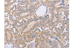 The image on the left is immunohistochemistry of paraffin-embedded Human thyroid cancer tissue using CSB-PA796533(BST1 Antibody) at dilution 1/40, on the right is treated with synthetic peptide. (Original magnification: 