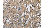 The image on the left is immunohistochemistry of paraffin-embedded Human thyroid cancer tissue using CSB-PA796667(CAB39L Antibody) at dilution 1/40, on the right is treated with fusion protein. (Original magnification: 