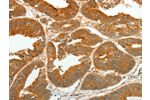 The image on the left is immunohistochemistry of paraffin-embedded Human colon cancer tissue using CSB-PA796684(ASCL1 Antibody) at dilution 1/30, on the right is treated with synthetic peptide. (Original magnification: 