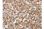 The image on the left is immunohistochemistry of paraffin-embedded Human thyroid cancer tissue using CSB-PA796730(BDH1 Antibody) at dilution 1/60, on the right is treated with fusion protein. (Original magnification: 
