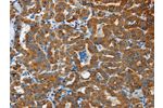 The image on the left is immunohistochemistry of paraffin-embedded Human thyroid cancer tissue using CSB-PA797254(FLCN Antibody) at dilution 1/40, on the right is treated with fusion protein. (Original magnification: 