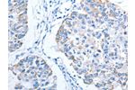 The image on the left is immunohistochemistry of paraffin-embedded Human breast cancer tissue using CSB-PA797270(ALAS1 Antibody) at dilution 1/15, on the right is treated with fusion protein. (Original magnification: 