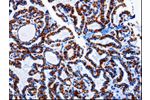 The image on the left is immunohistochemistry of paraffin-embedded Human thyroid cancer tissue using CSB-PA797497(ARL6 Antibody) at dilution 1/10, on the right is treated with fusion protein. (Original magnification: 