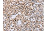 The image on the left is immunohistochemistry of paraffin-embedded Human prostate cancer tissue using CSB-PA798103(EDA Antibody) at dilution 1/40, on the right is treated with synthetic peptide. (Original magnification: 
