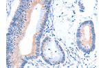 The image on the left is immunohistochemistry of paraffin-embedded Human colon cancer tissue using CSB-PA798115(ACAD8 Antibody) at dilution 1/15, on the right is treated with fusion protein. (Original magnification: 