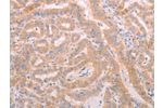 The image on the left is immunohistochemistry of paraffin-embedded Human thyroid cancer tissue using CSB-PA798156(ADAMTS10 Antibody) at dilution 1/20, on the right is treated with synthetic peptide. (Original magnification: 