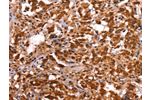 The image on the left is immunohistochemistry of paraffin-embedded Human thyroid cancer tissue using CSB-PA798292(ESRRB Antibody) at dilution 1/40, on the right is treated with synthetic peptide. (Original magnification: 