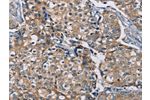 The image on the left is immunohistochemistry of paraffin-embedded Human breast cancer tissue using CSB-PA798772(AAAS Antibody) at dilution 1/20, on the right is treated with fusion protein. (Original magnification: 