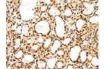 The image on the left is immunohistochemistry of paraffin-embedded Human thyroid cancer tissue using CSB-PA798773(AGPAT9 Antibody) at dilution 1/25, on the right is treated with synthetic peptide. (Original magnification: 