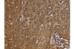 The image on the left is immunohistochemistry of paraffin-embedded Human cervical cancer tissue using CSB-PA798885(FHL2 Antibody) at dilution 1/50, on the right is treated with fusion protein. (Original magnification: 
