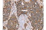 The image on the left is immunohistochemistry of paraffin-embedded Human cervical cancer tissue using CSB-PA799040(FUCA1 Antibody) at dilution 1/30, on the right is treated with fusion protein. (Original magnification: 
