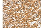The image on the left is immunohistochemistry of paraffin-embedded Human thyroid cancer tissue using CSB-PA799580(ANKMY2 Antibody) at dilution 1/30, on the right is treated with fusion protein. (Original magnification: 