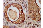 IHC image of CSB-PA800102LA01HU diluted at 1:400 and staining in paraffin-embedded human cervical cancer performed on a Leica BondTM system. After dewaxing and hydration, antigen retrieval was mediated by high pressure in a citrate buffer (pH 6.0). Sectio