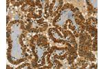 The image on the left is immunohistochemistry of paraffin-embedded Human thyroid cancer tissue using CSB-PA800200(CHRDL2 Antibody) at dilution 1/20, on the right is treated with synthetic peptide. (Original magnification: 