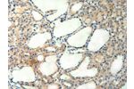 The image on the left is immunohistochemistry of paraffin-embedded Human thyroid cancer tissue using CSB-PA801486(AGRN Antibody) at dilution 1/50, on the right is treated with synthetic peptide. (Original magnification: 