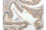 The image on the left is immunohistochemistry of paraffin-embedded Human colon cancer  tissue using CSB-PA801690(ADAMTS2 Antibody) at dilution 1/25, on the right is treated with synthetic peptide. (Original magnification: 