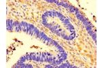 Immunohistochemistry of paraffin-embedded human ovarian cancer using CSB-PA801816LA01HU at dilution of 1:100