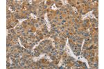 The image on the left is immunohistochemistry of paraffin-embedded Human liver cancer tissue using CSB-PA801951(DDX53 Antibody) at dilution 1/75, on the right is treated with fusion protein. (Original magnification: 