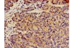 Immunohistochemistry of paraffin-embedded human ovarian cancer using CSB-PA804805LA01HU at dilution of 1:100